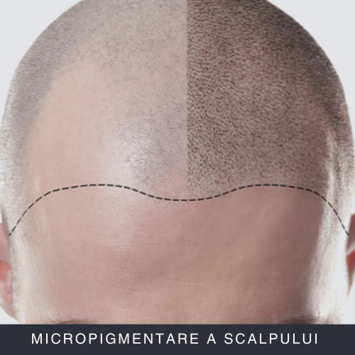 Micropigmentare a Scalpului Curs Online