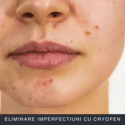 Eliminare imperfectiuni cu CryoPen Curs Online