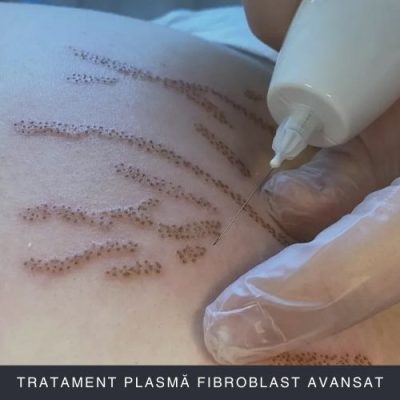 Tratament Plasmă Fibroblast Avansat Curs Online