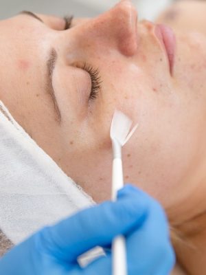 Tratament Peeling Chimic Facial